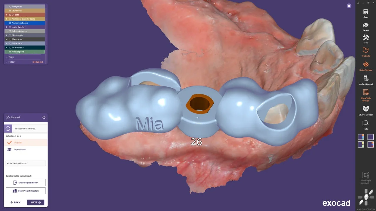 Exocad Exoplan 